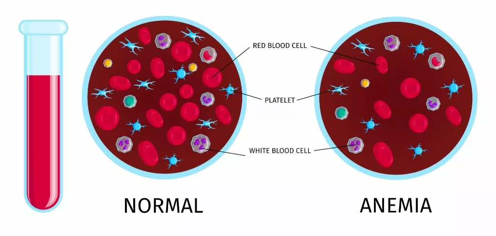 A anemia é uma das principais consequências da deficiência de ferro. Fonte da imagem: Freepik.